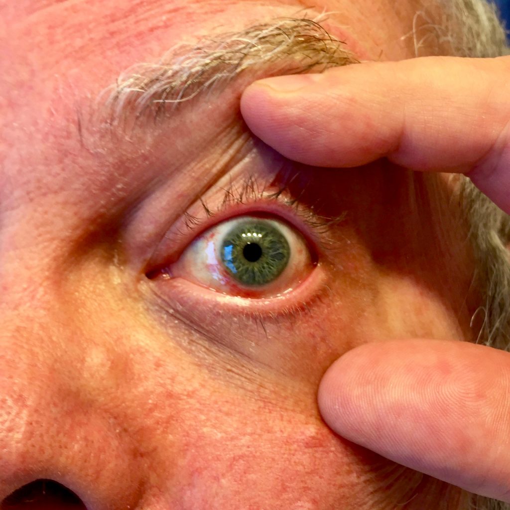 eye bruising