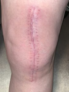 6 week knee photo