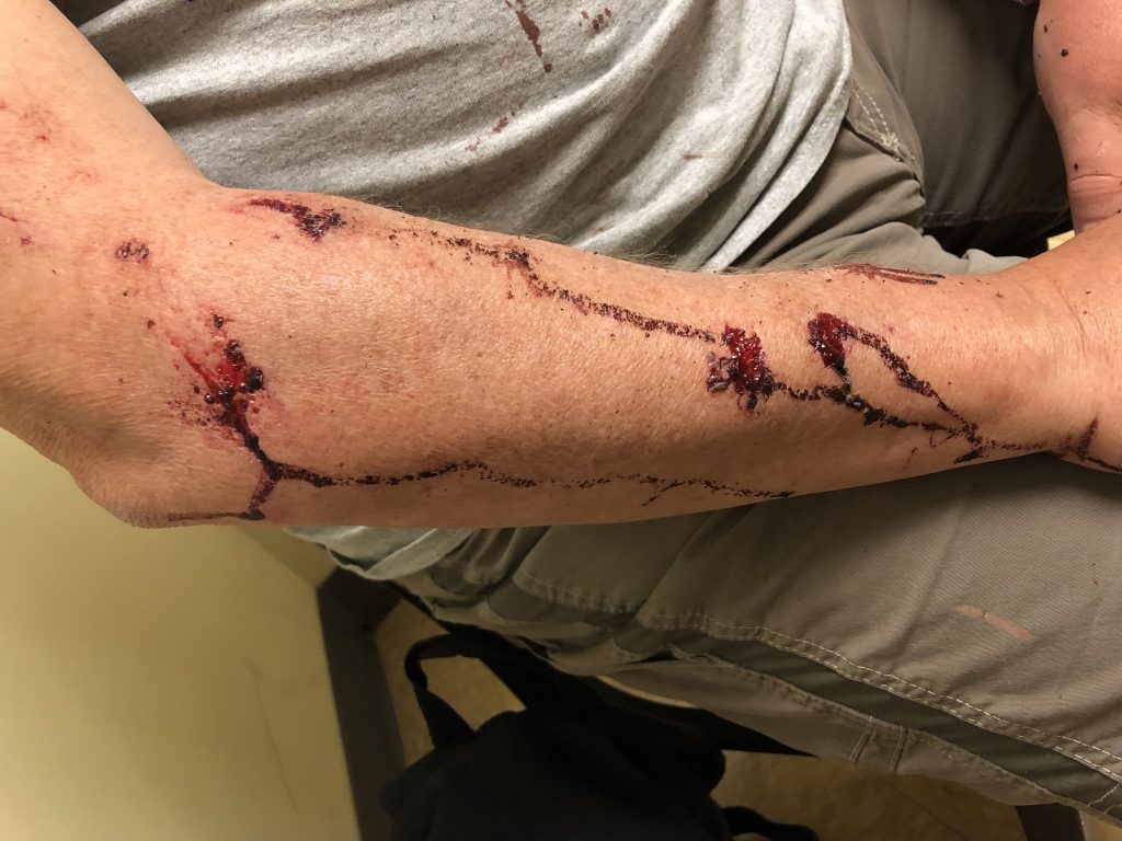 Abrasions on my right arm