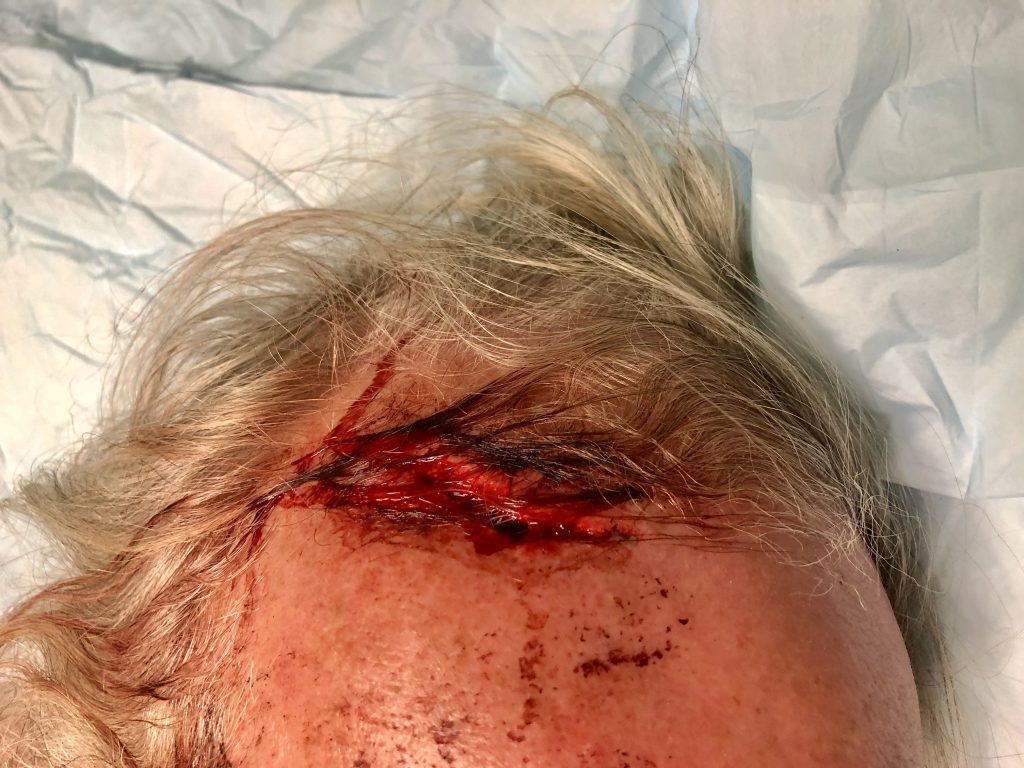 Head wound