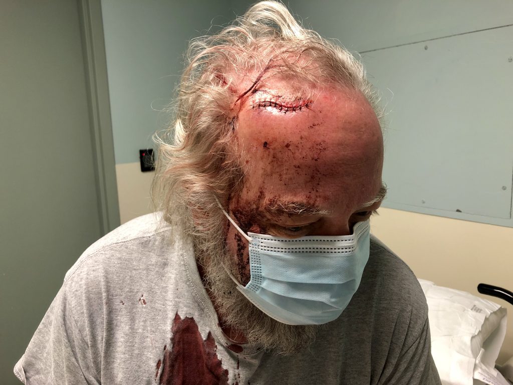 Freshly-stitched forehead